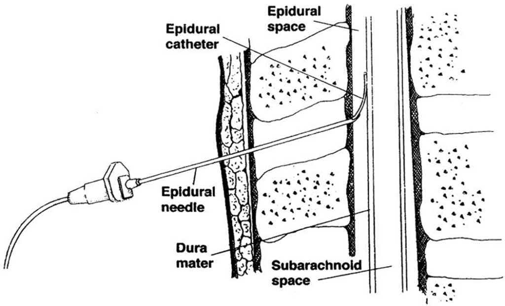 What You Need to Know about Epidural Anesthesia versus Unmedicated Birth